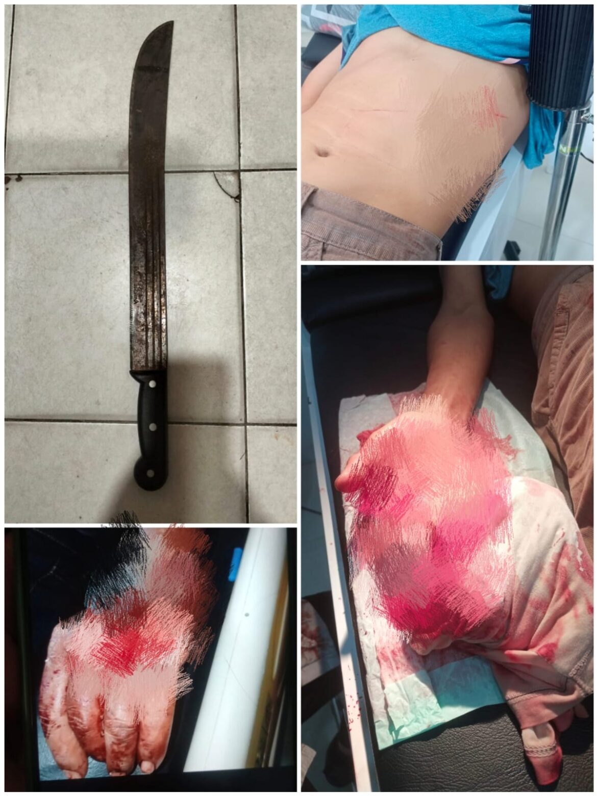 KORBAN PENGEROYOKAN – Akibat dikeroyok, korban bernama Sahrul mengalami luka robek pada bagian punggung telapak tangan kiri dan punggung sebelah kiri, Kamis (5/2/2026) lalu. (foto: istimewa)